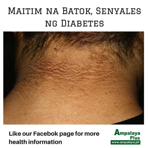 maitim na batok diabetes